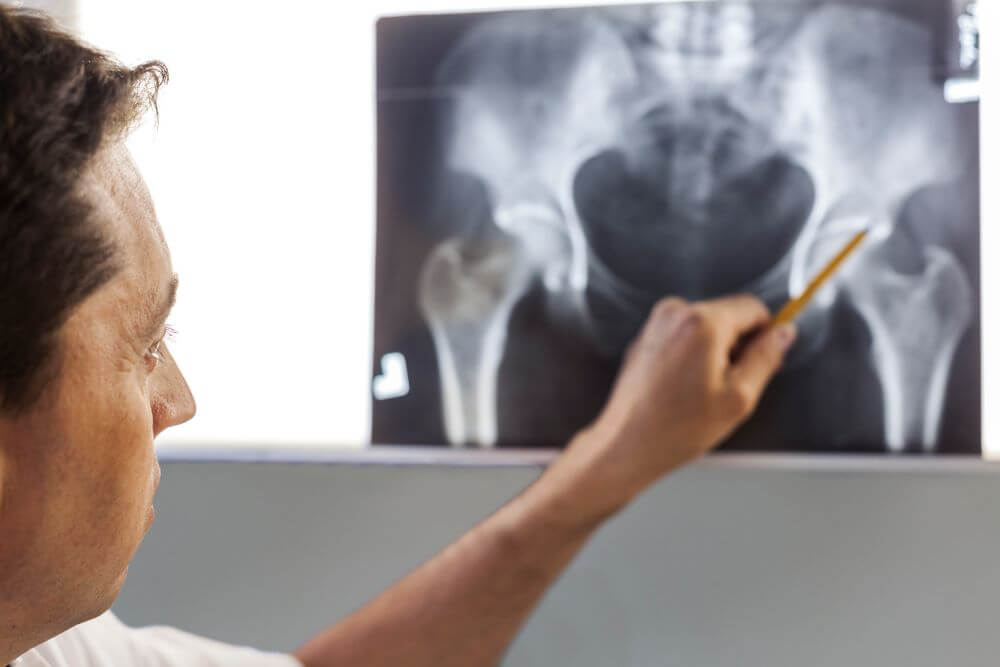 Dementia Fall hip xray